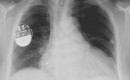 X-ray of the thorax with a pacemaker in situ (credit: Lucien Monfils via Wikimedia)