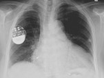 X-ray of the thorax with a pacemaker in situ (credit: Lucien Monfils via Wikimedia)